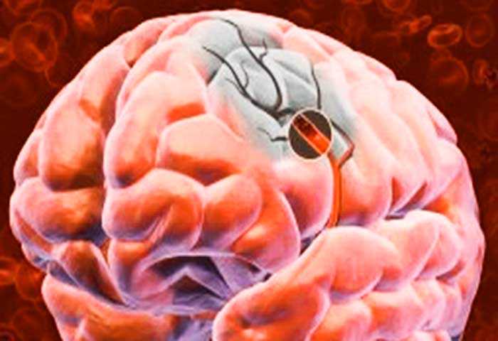 Головного мозга атеросклероз народное средство